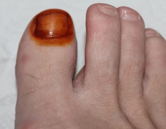 A gomba jód kezelése