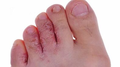 A gomba fejlődésének típusai és szakaszai a lábakon