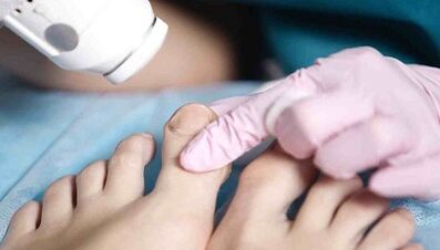 A gomba hardverkezelése a lábakon