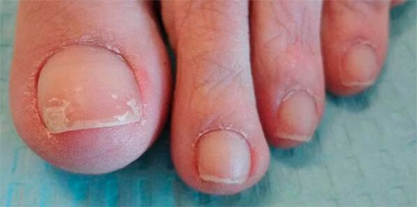 A gombás lábak szakaszai