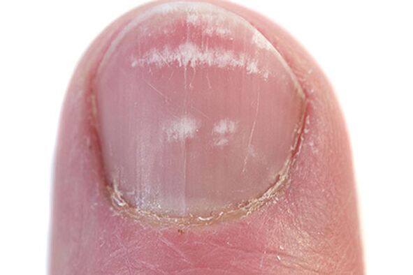 Az első jelek és tünetek