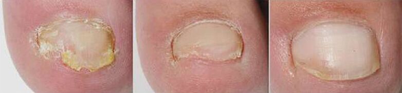 Terápiás eredmények