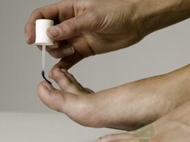 A körömgomba kezelése