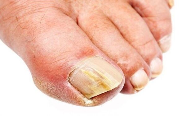 Onychomycosis - körömgomba